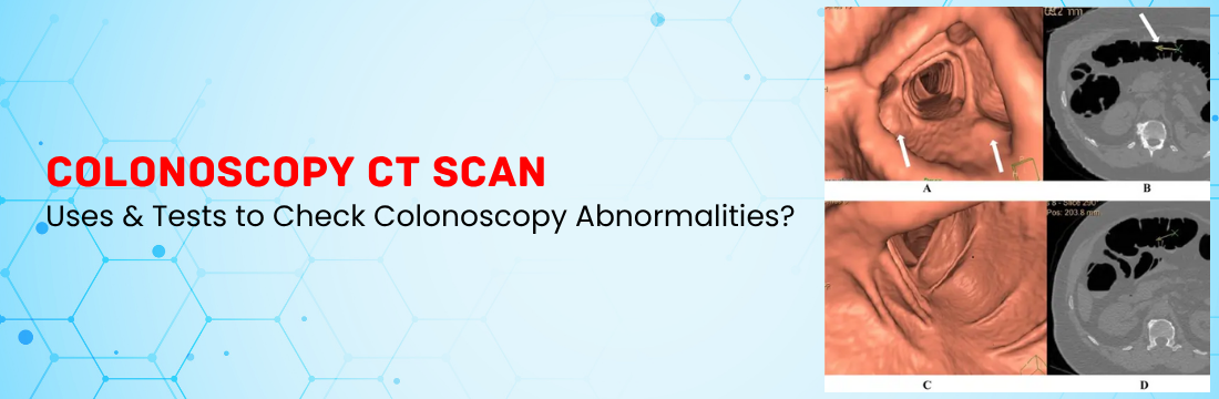 CT Colonoscopy and Its Uses